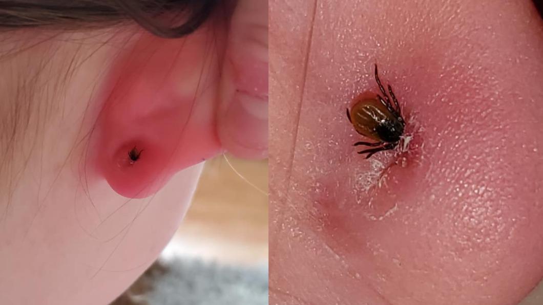 澳洲女子發現蜱蟲躲在女兒的耳環後方。（圖／翻攝自每日郵報）