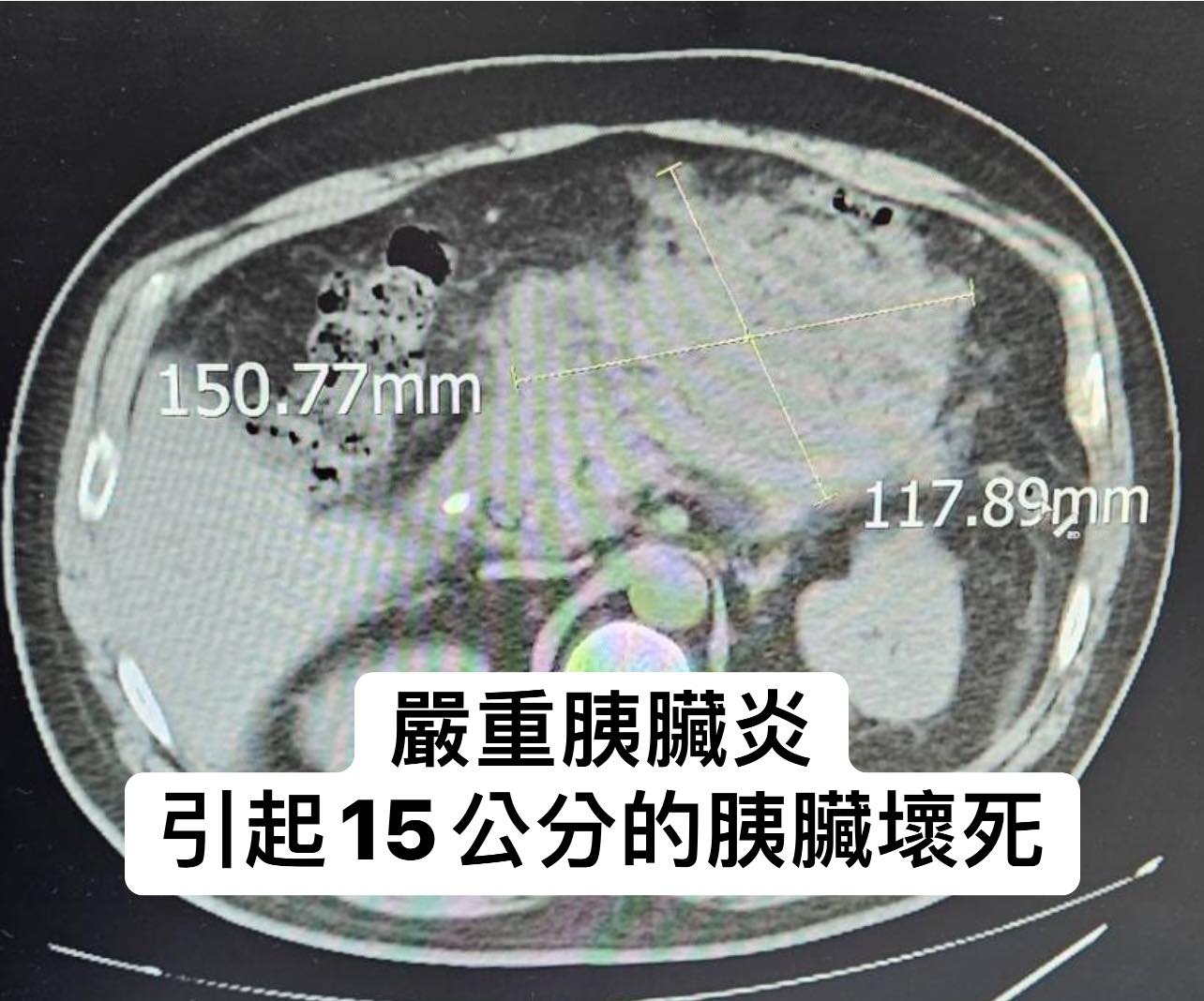 40歲男胰臟炎導致胰臟嚴重壞死。（圖／翻攝自林相宏醫師臉書）