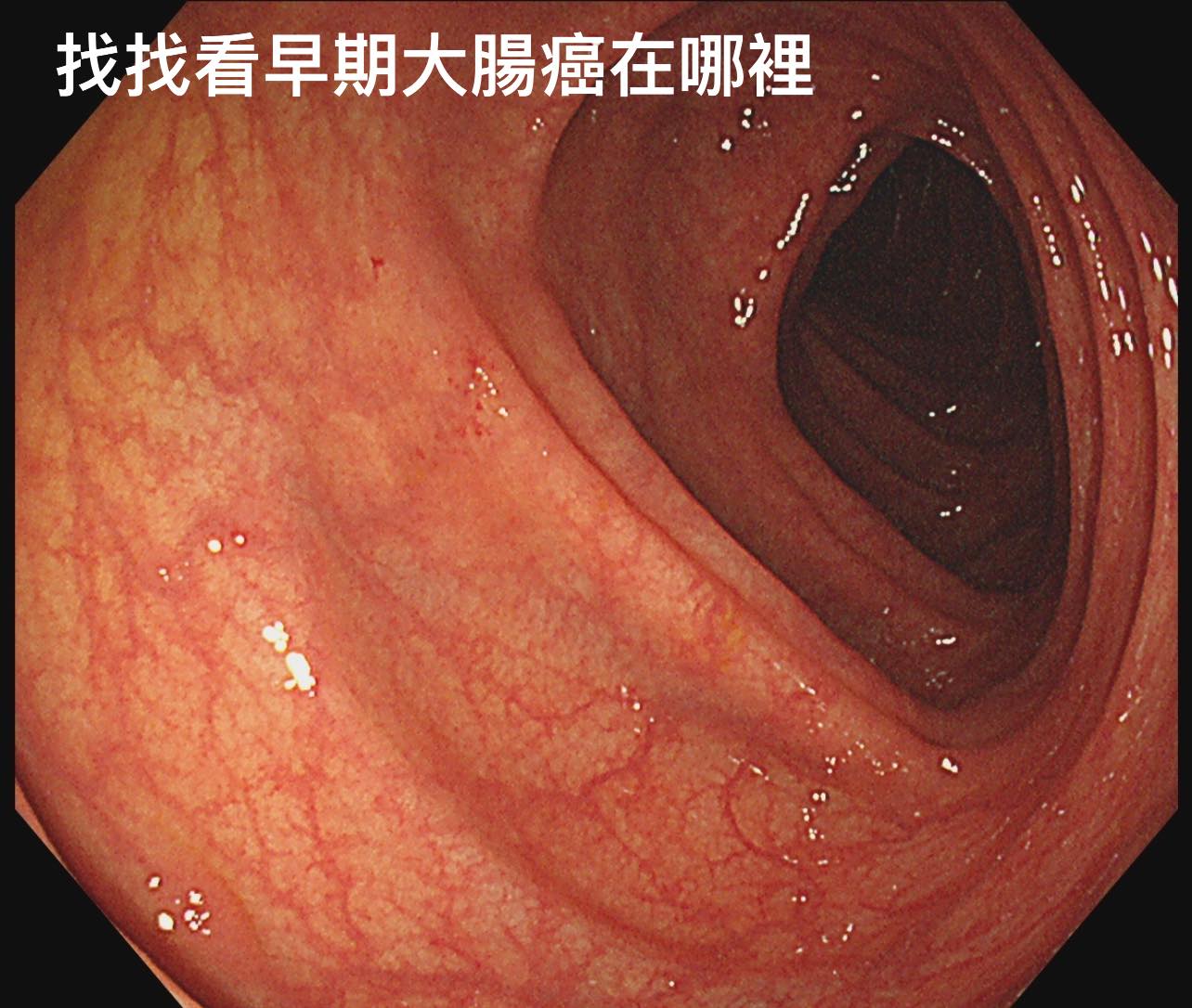 禾馨民權健康管理診所院長林相宏在臉書貼出一張患者的大腸鏡照片，患者大腸息肉不到1公分。（圖／翻攝胰臟醫師 林相宏 禾馨民權內科診所 臉書）