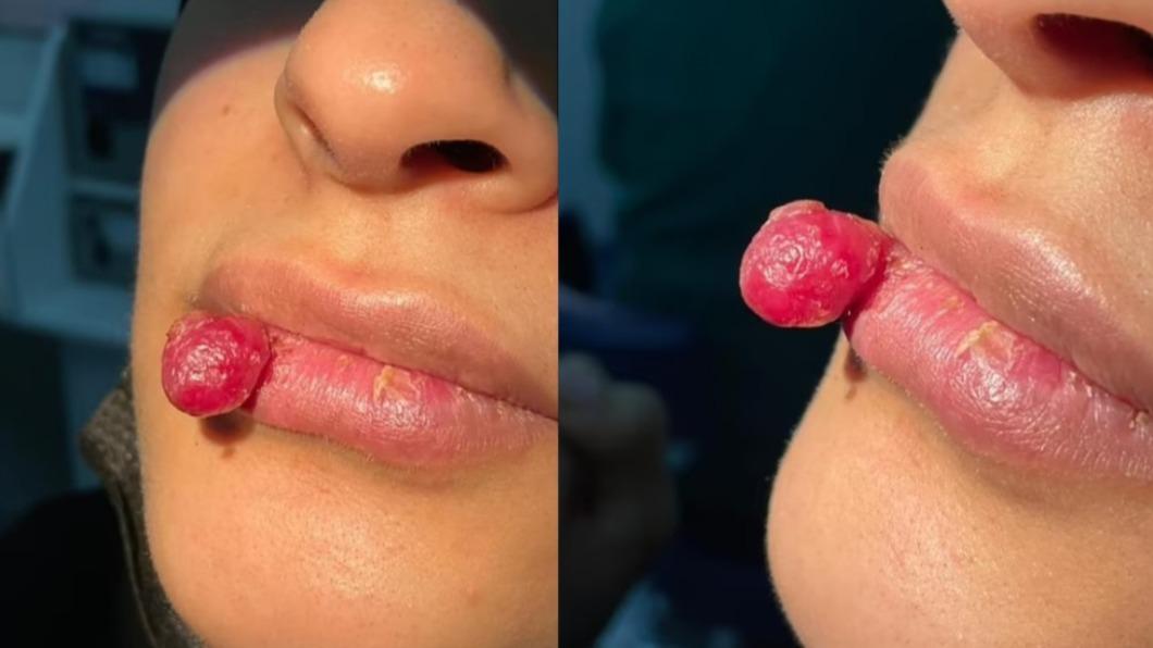 26歲女子不小心弄傷右下唇後，竟出現腫瘤。（圖／翻攝自《每日郵報》）