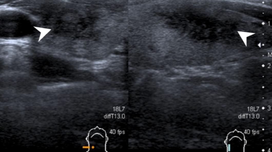 該甲狀腺超音波可以看到發炎部位呈現低迴音。（圖／萬芳醫院提供）
