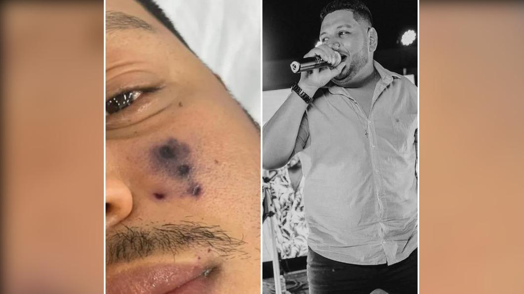 巴西歌手莫拉斯，疑似遭蜘蛛咬傷造成瘀血發黑死亡。（圖／翻攝自@gilgomeslima）
