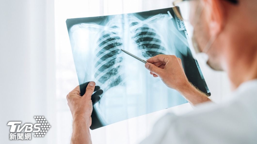 Lung cancer now leading cancer type in Taiwan (Shutterstock) Lung cancer now leading cancer type in Taiwan