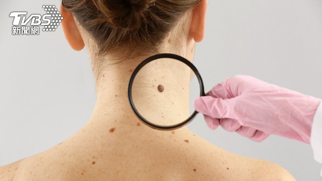 一名54歲婦女以為臉上的斑疤是炒菜被油濺起的傷痕，化驗出來卻是「基底細胞癌」。（示意圖，非當事人／Shutterstock達志影像）