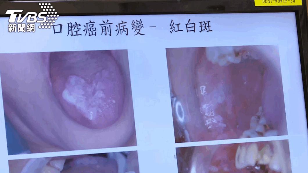 長期嚼食檳榔,易導致口腔癌。(圖/TVBS)