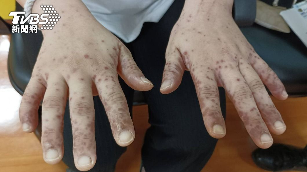 蕭女的小孩曾在不久前確診腸病毒。（圖／TVBS）