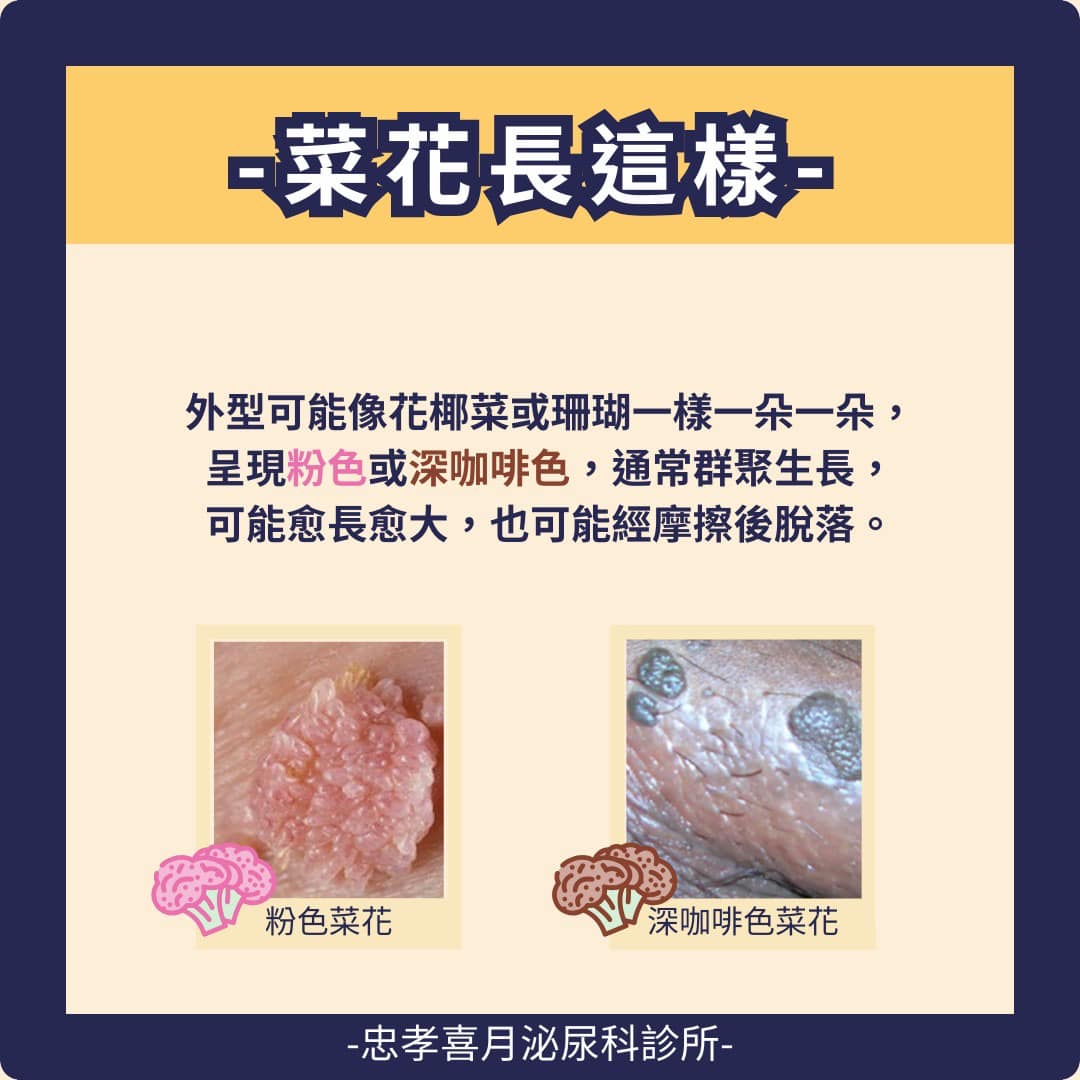 菜花外型可能花椰菜，或是珊瑚一樣。（圖／翻攝自忠孝喜月泌尿科診所臉書）