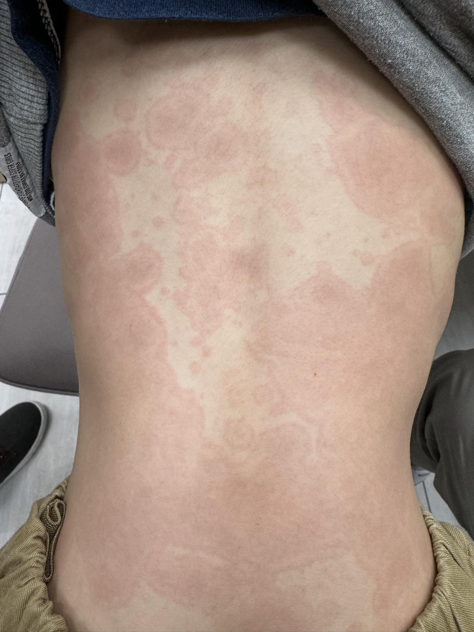 一名小學生感染黴漿菌，背部爬滿紅斑。（圖／翻攝自顏俊宇臉書）