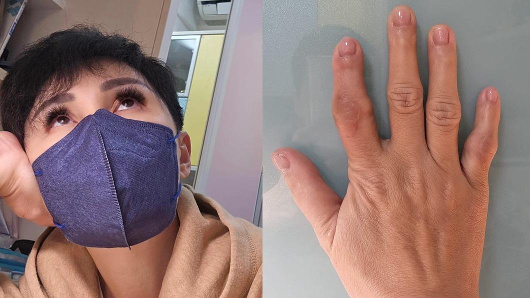 名嘴王瑞玲在紅斑性狼瘡發作後手指關節變形。（圖／翻攝自王瑞玲醫藥美食記者臉書）