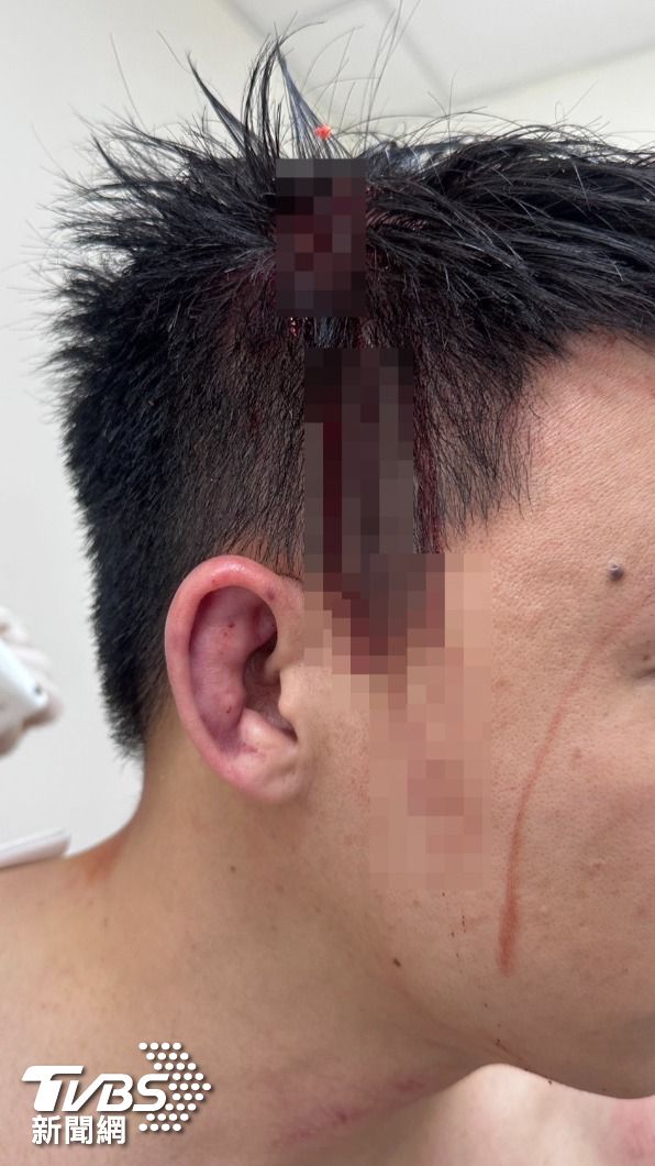 Toyz血流不止，甚至血流到臉頰。（圖／TVBS）