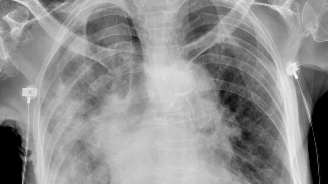 ，蘇一峰也在臉書PO出患者「大白肺」Ｘ光片，同時指出現在醫院病人比以往多了四到五成。（圖／翻攝蘇一峰臉書）