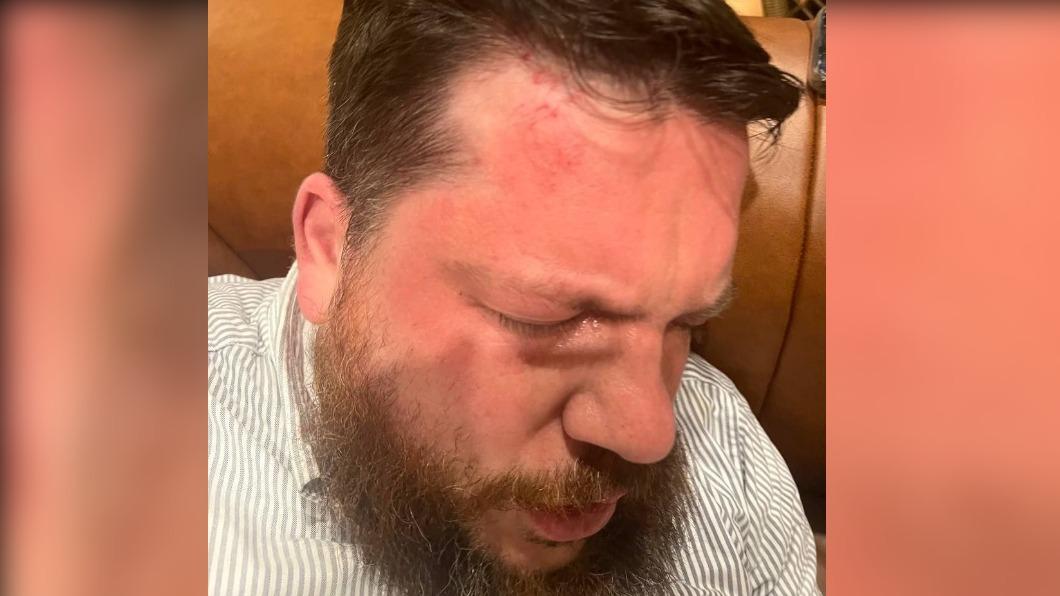 沃爾科夫遭鐵鎚攻擊，臉被打腫、出現瘀傷。（圖／翻攝自@ACF_int推特）