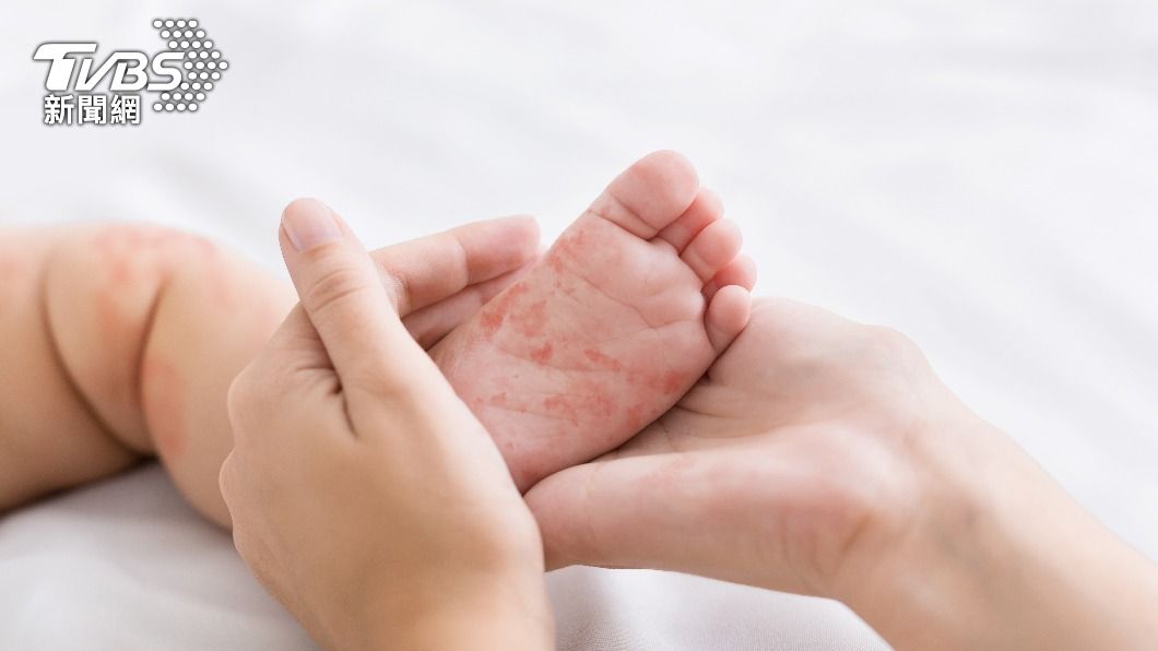 日本東京一名未滿5歲男童確診麻疹，為今年東京都第3例確診麻疹的患者。（示意圖／Shutterstock達志影像）
