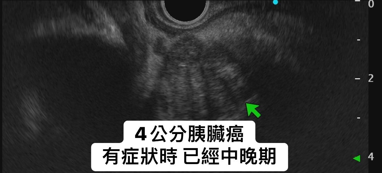 50歲女暴瘦9公斤,罹患胰臟癌中晚期。(圖/翻攝自林相宏臉書)