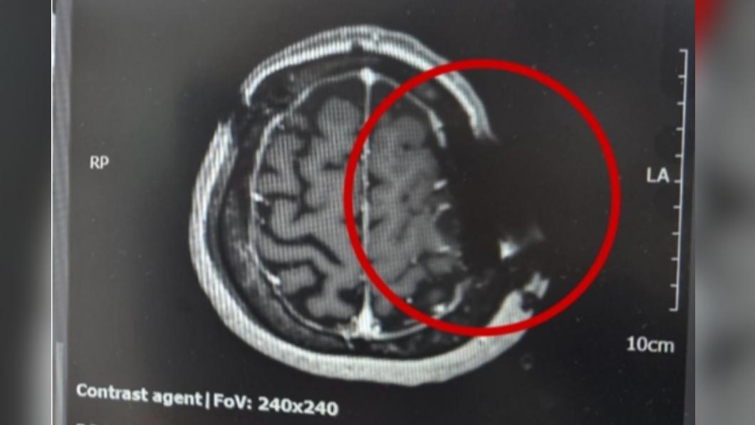 韓國一名患者進行腦瘤手術後，發現鋸子片還嵌在頭骨上。（圖／翻攝自韓聯社）