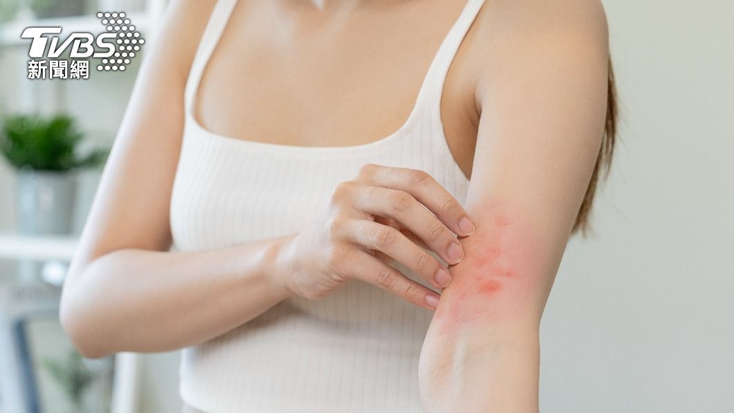 濕疹泛指「引發皮膚紅腫和發炎的皮膚病」。（示意圖／shutterstock達志影像） 