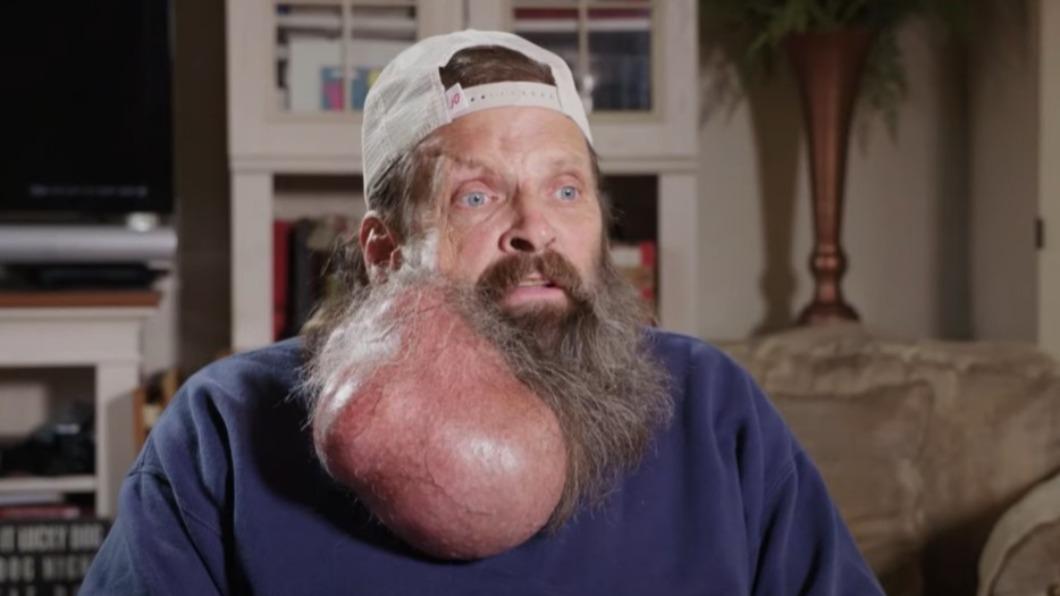 美國男子提姆的右邊耳朵下方長了顆重達5.5磅（約2.5公斤）的粉瘤。（圖／翻攝自YouTube@TLC）