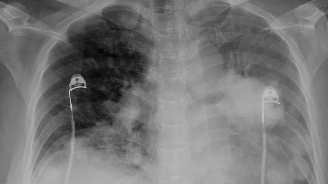 60歲病患連續咳嗽4個月，一檢查發現肺癌末期。（圖／翻攝自蘇一峰臉書）