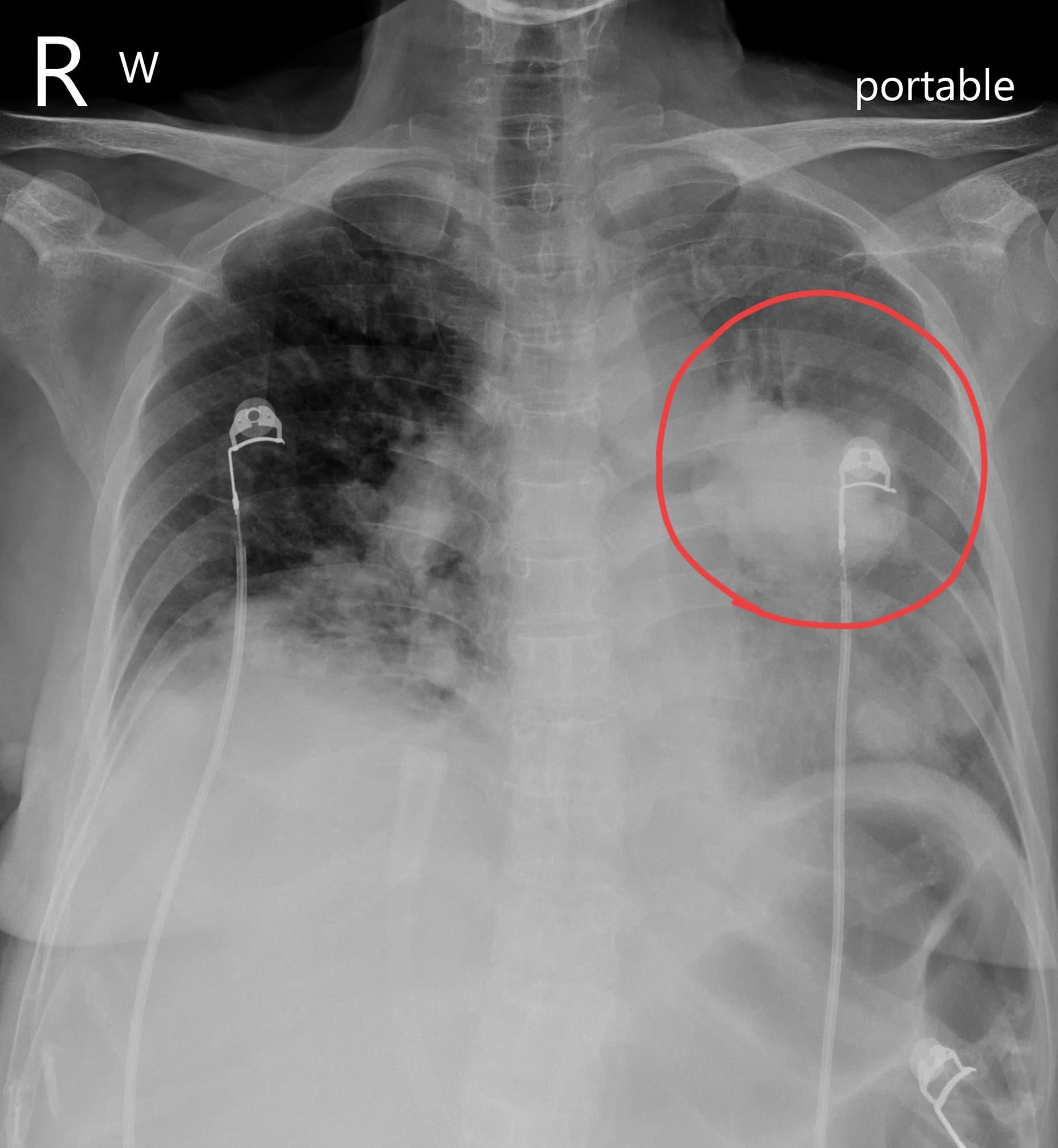 患者肺部有10公分大腫瘤,咳到喘才就醫。(圖/翻攝自蘇一峰臉書)