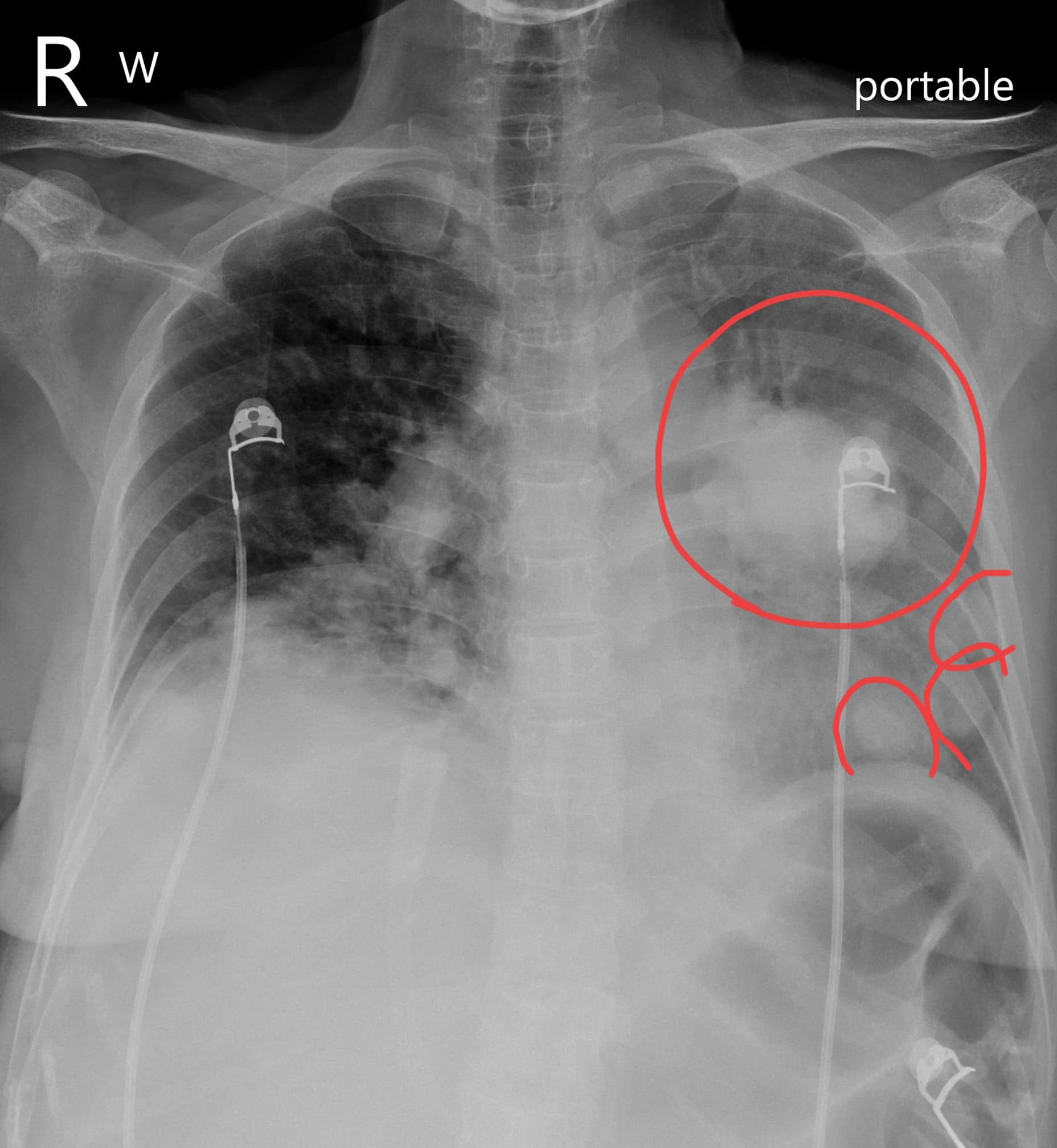 患者腫瘤到處轉移還破裂內出血。(圖/翻攝自蘇一峰臉書)