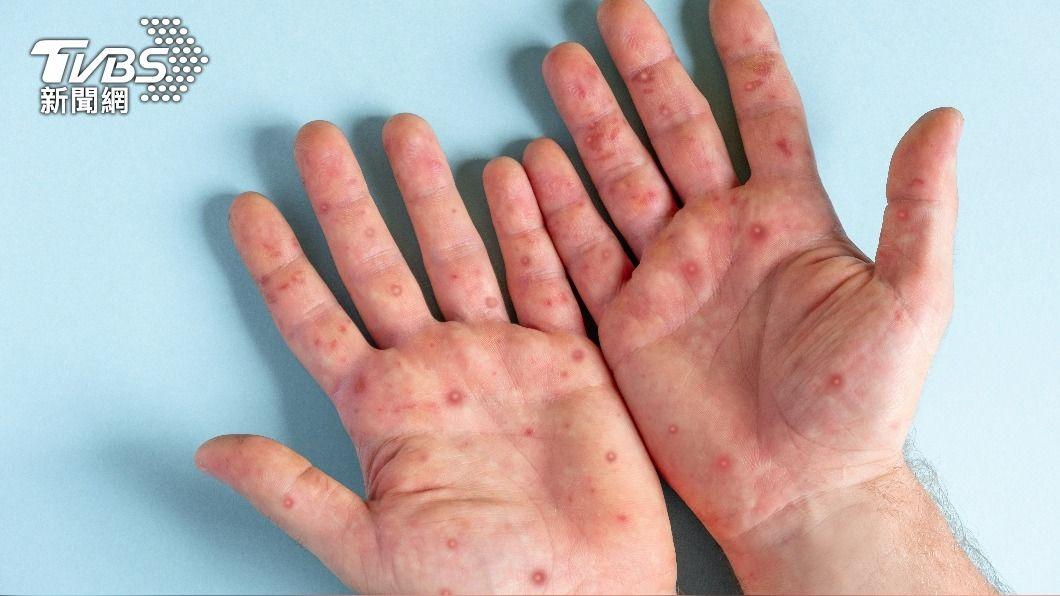 腸病毒常見的症狀為口腔、手掌、腳掌出現水泡、潰瘍。（示意圖／shutterstock達志影像）