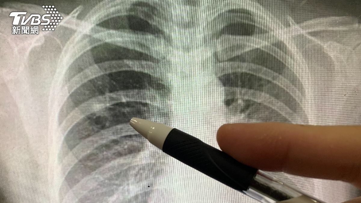 肺癌在台灣達到三個第一名，「死亡人數第一、發生人數第一、健保花錢第一」的癌症。（圖／TVBS）