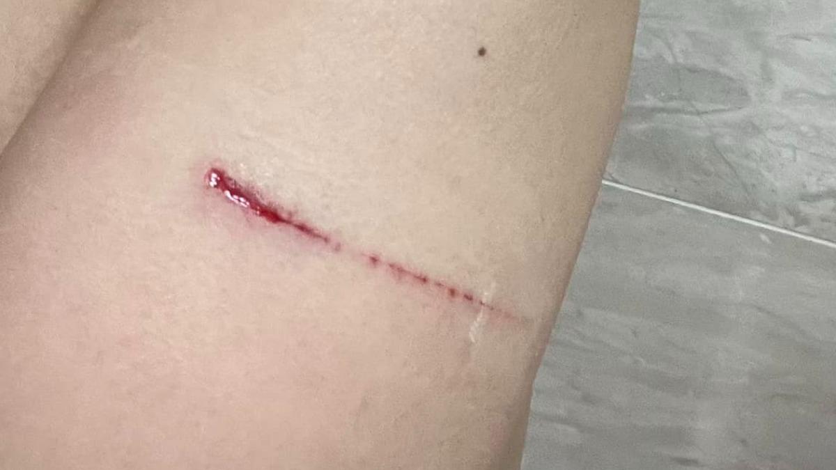 李蒨蓉曬出手臂上一道長長的血痕。（圖／翻攝自李蒨蓉臉書）