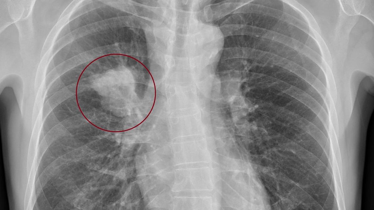 50歲男在鎖骨上凹窩摸到硬塊，驚罹患肺癌。（圖／翻攝自蘇一峰臉書）