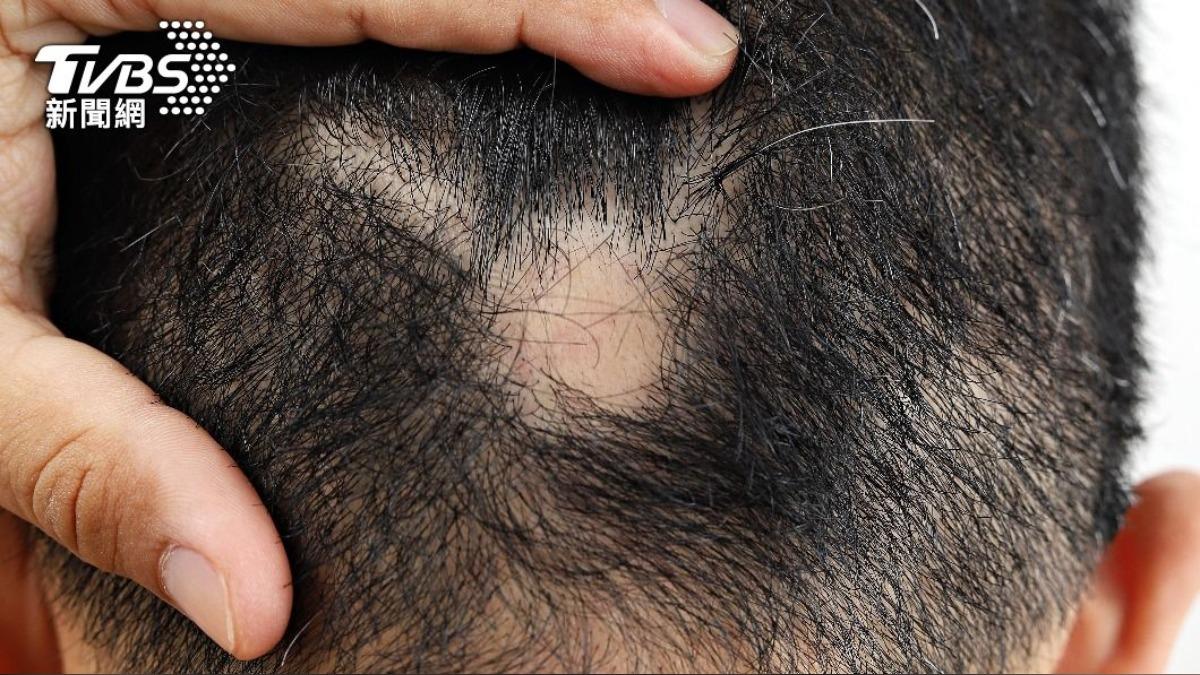 梅毒螺旋菌會攻擊毛囊，導致脫髮。（示意圖，非當事人／Shutterstock達志影像）