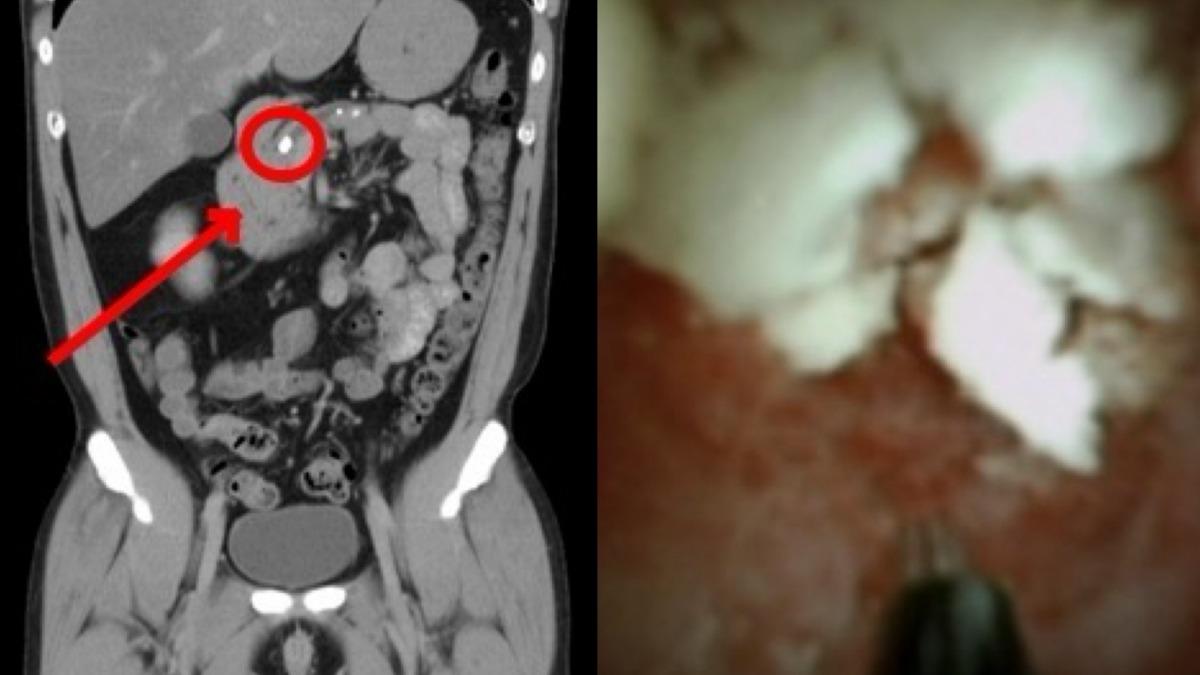 一名40多歲男性「胰臟胰管」內出現一顆約1公分的結石，導致胰管嚴重阻塞進而發生「胰臟炎」。（圖／醫院提供）