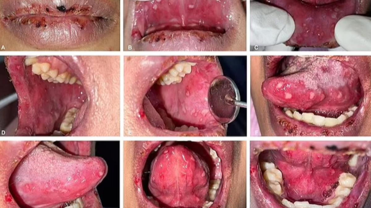 使用電子菸一年後，印尼年輕女子口腔內外出現大量潰瘍。（圖／翻攝自期刊SANTOS et al. ）
