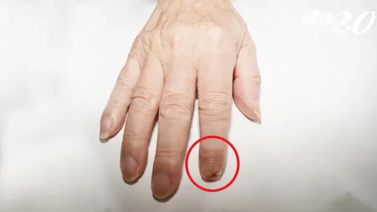 甲床鱗狀細胞癌是指甲最常見的惡性腫瘤，好發於中老年男性。（圖／楊雅棠醫師提供）