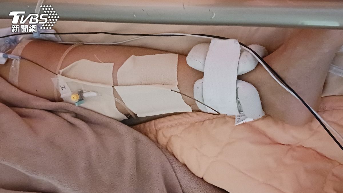 蒙古27歲少婦遠赴3000公里外台灣求救 因左下肢靜脈栓塞脹痛