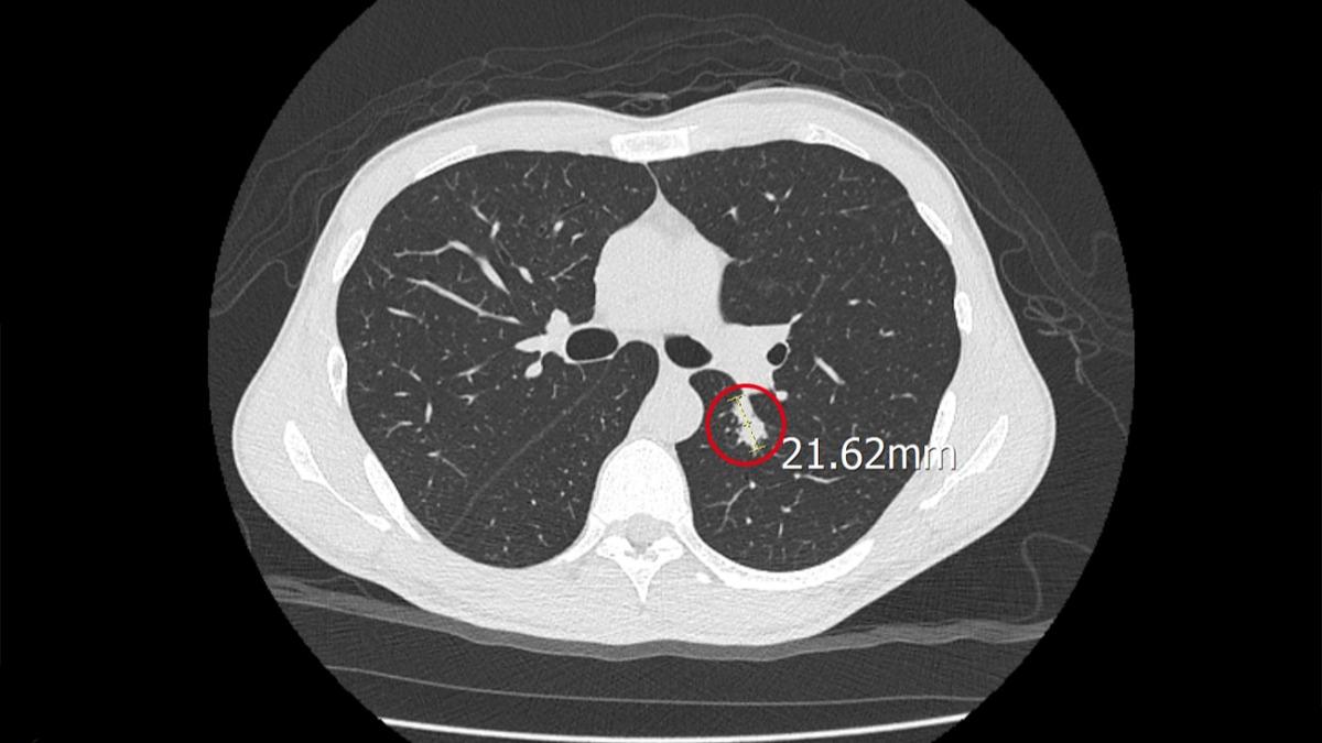 患者健檢發現左下肺葉有2公分腫瘤，竟是罕見的在台灣罕見「球黴菌」感染（圖／中港澄清醫院提供）