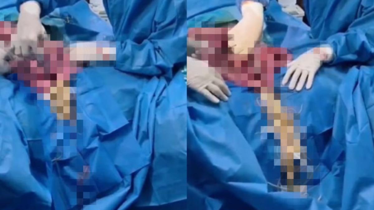 大量蛔蟲爬滿手術台畫面讓醫護看傻。（圖／翻攝自@EM_RESUS　X）