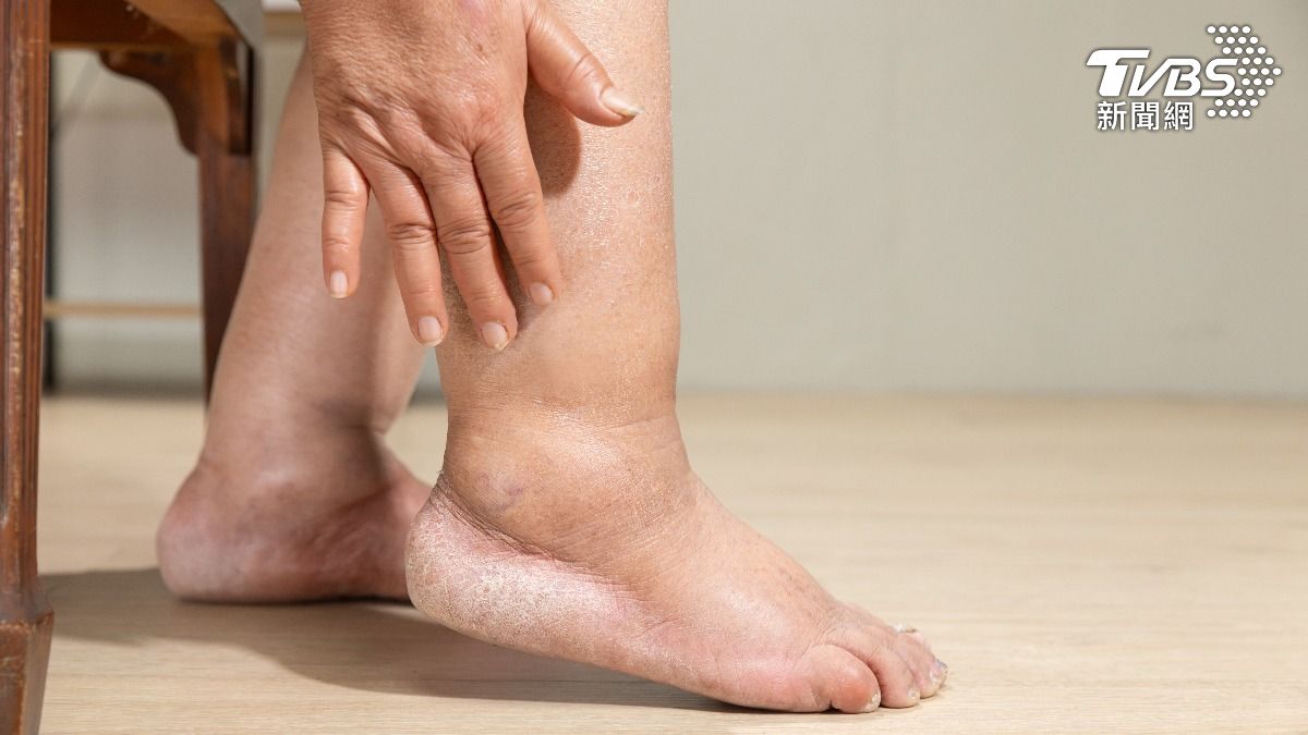 若水腫太久恐需注意身體狀況。（示意圖，非當事人／shutterstock達志影像）