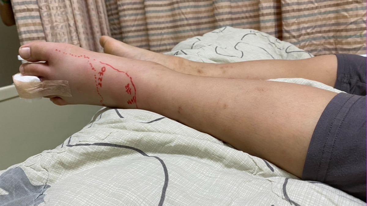 男童腳趾腫脹住院一周。（圖／新上國小校長提供）