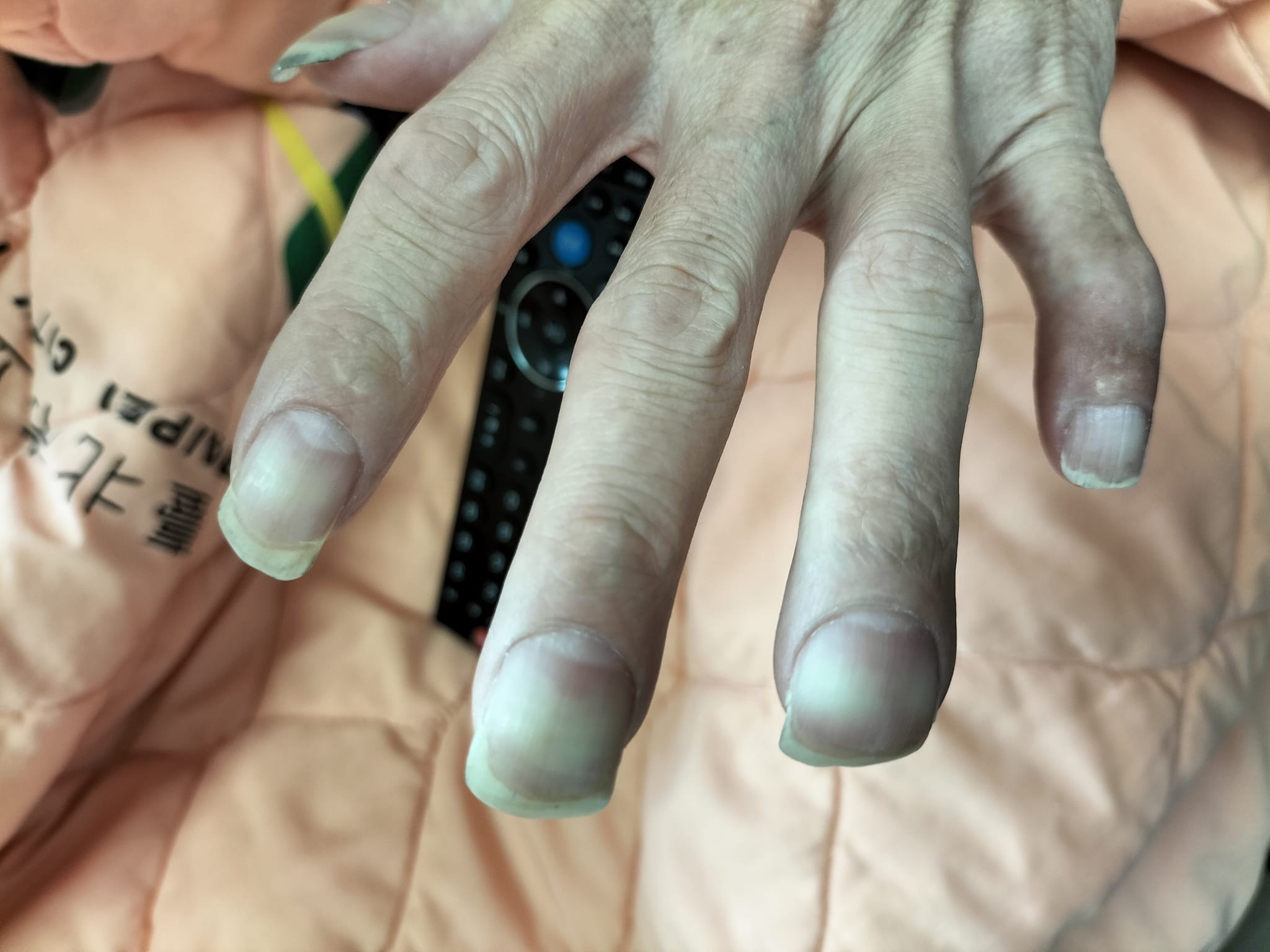 杵狀指是手指或腳趾末節呈肥厚膨大的畸形現象。（圖／翻攝自蘇一峰臉書）