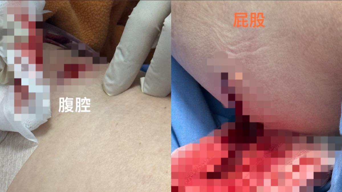 吳小姐腹部及臀部穿刺傷。(圖/民眾提供)