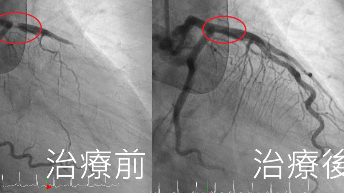 曾男左前降支冠狀動脈阻塞高達99%，屬於極為致命的血管病變。（圖／亞大附醫提供）