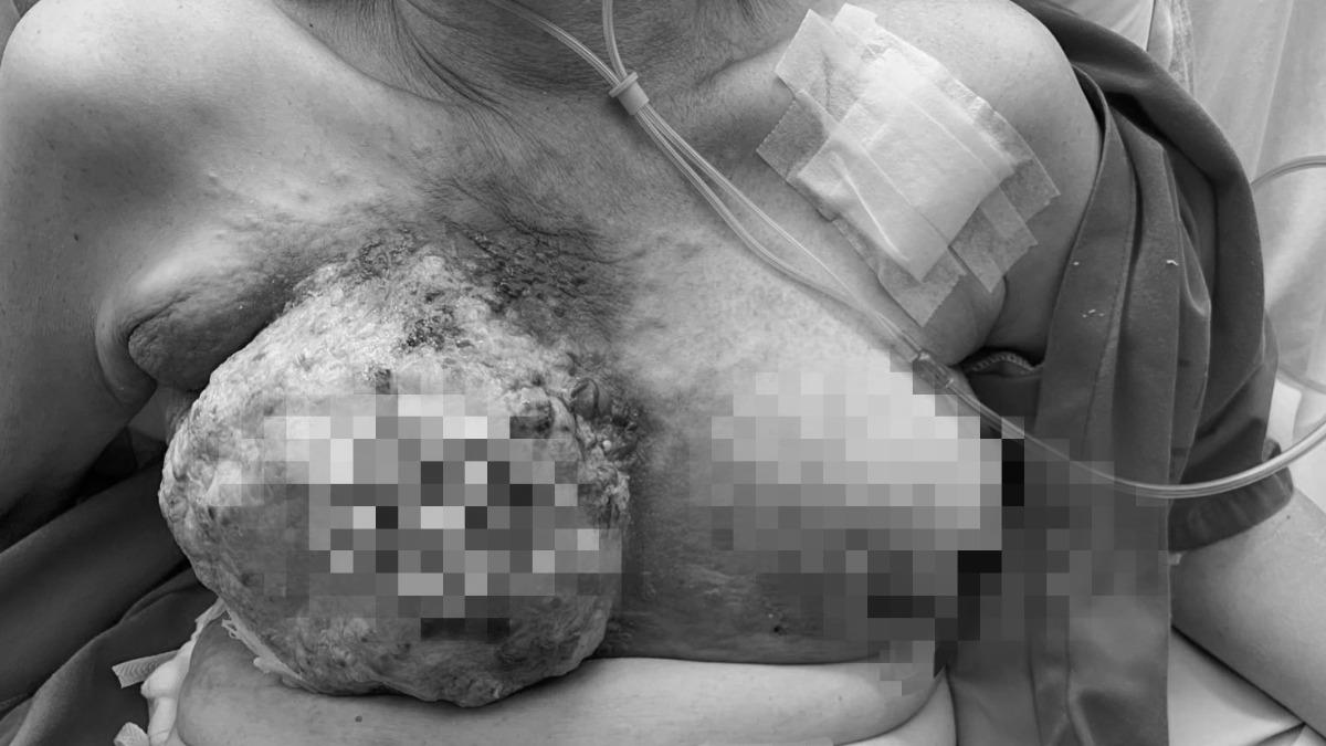 台中市一名44歲陳姓女子，因為拖延就醫使乳癌變成第四期。（圖／台中醫院提供）
