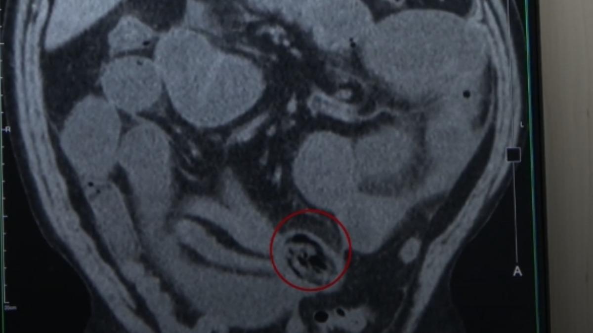 該名40歲男子因將香菇快速吞下肚，導致腸阻塞。（圖／院方提供）