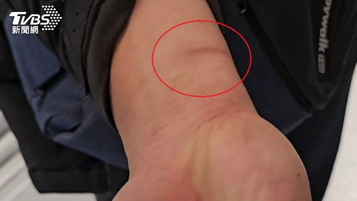 遭手銬銬上傷痕。（圖／TVBS）