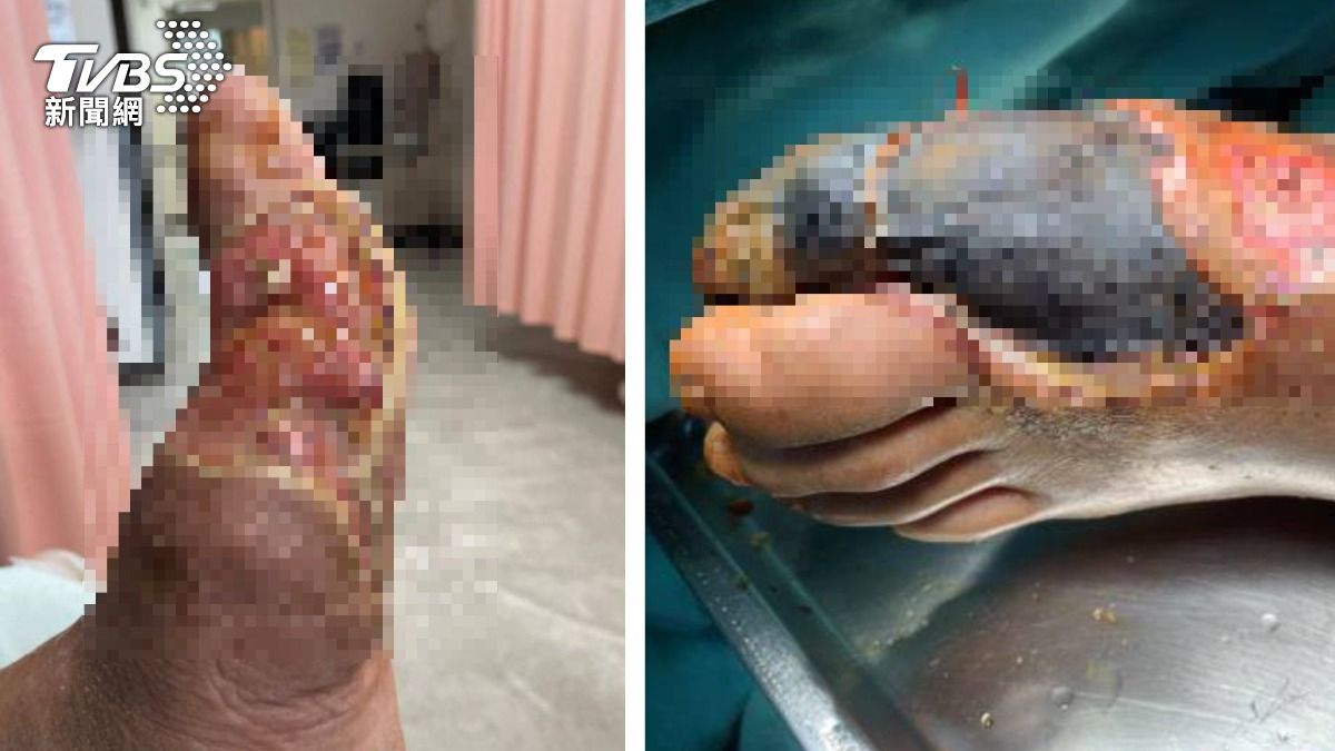 男患者險截肢。（圖／TVBS）