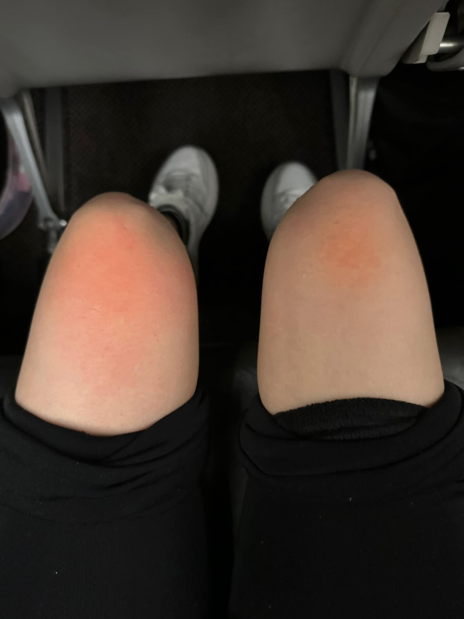 佩佩被滾燙的熱茶燙傷。（圖／翻攝自「雙胞胎佩佩 韓式婚紗女王」臉書）