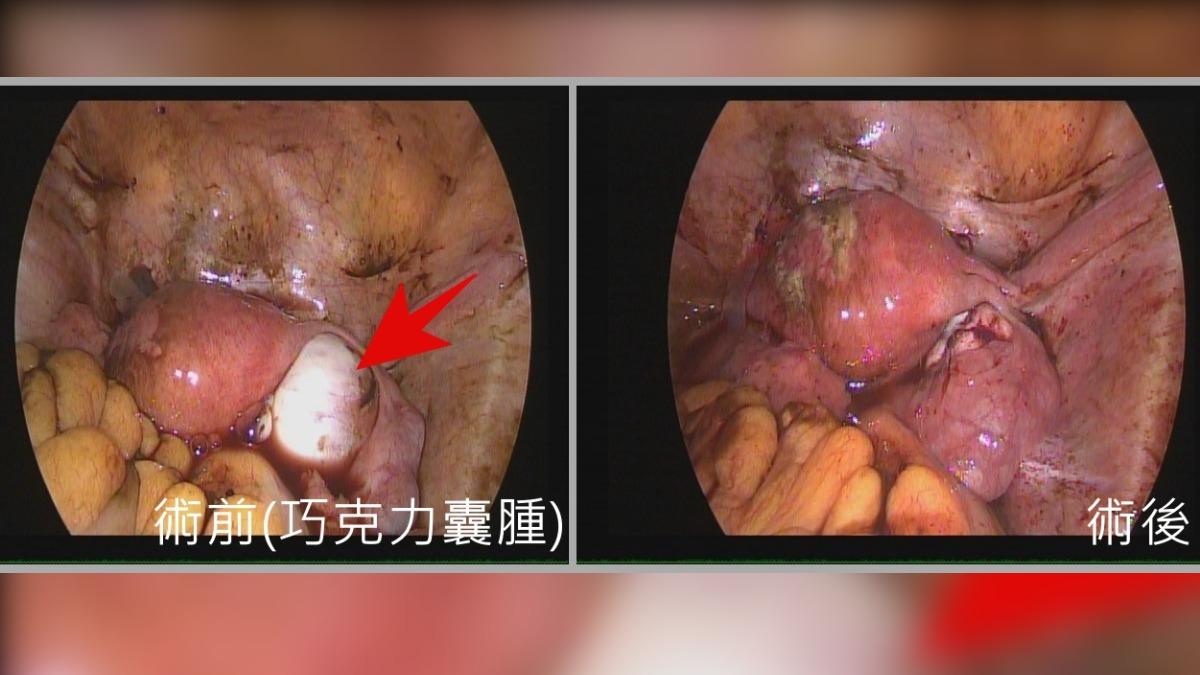 台中女卵巢長出巧克力囊腫，且還破裂導致急性腹膜炎。（圖／亞大附醫提供）
