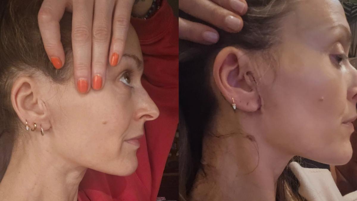 菲妮科頓曝光術後傷疤恢復狀況。（圖／翻攝自IG ＠fearnecotton）