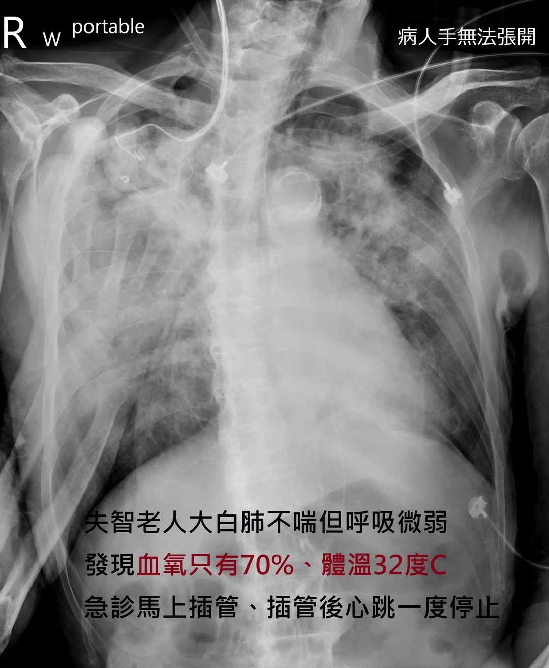 這名失智老人都已大白肺卻不喘。（圖／翻攝自蘇一峰臉書）