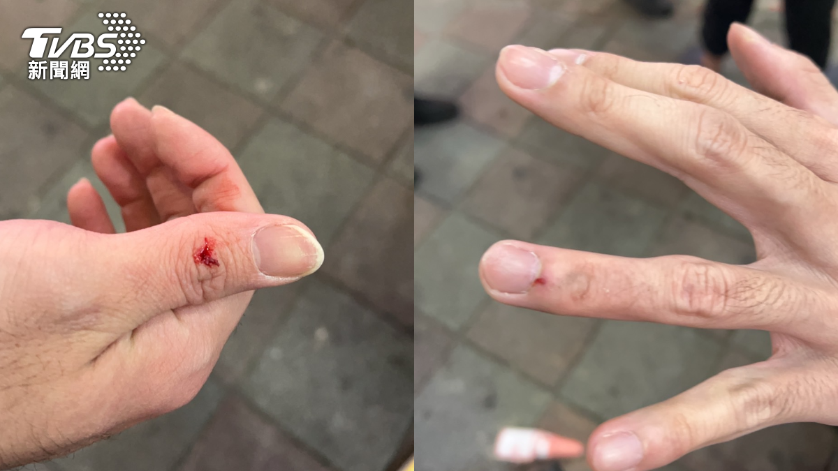 因男子搶奪推擠行為造成警員手部受傷。（圖／TVBS）