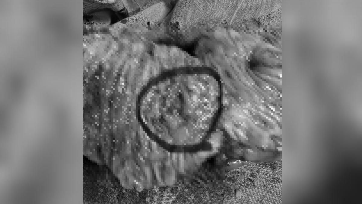 超哥做切除手術。（圖／超哥提供）